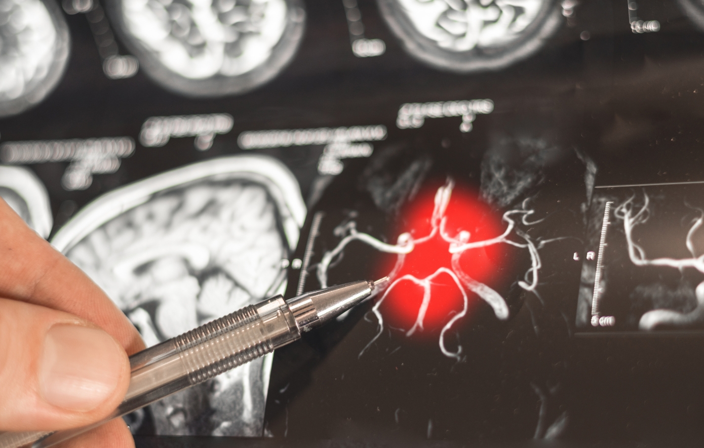 Αλτσχάιμερ: Τεχνητή νοημοσύνη προβλέπει τη νόσο Διάγνωση Αλτσχάιμερ με τεχνητή νοημοσύνη και μαγνητική τομογραφία