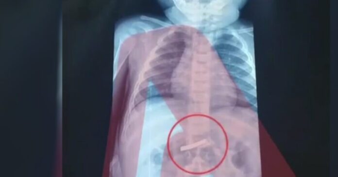 Τρίχρονος κατάπιε ξυραφάκι νοσοκομείο Παίδων Αθήνα