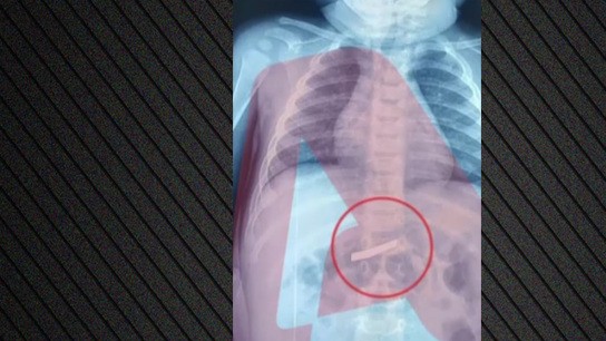 Τρίχρονος κατάπιε ξυραφάκι νοσοκομείο Παίδων Αθήνα